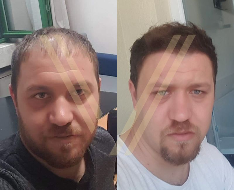 4000 grafts hair transplant befre and after photo