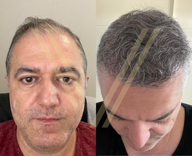 4000 Grafts Hair Transplant