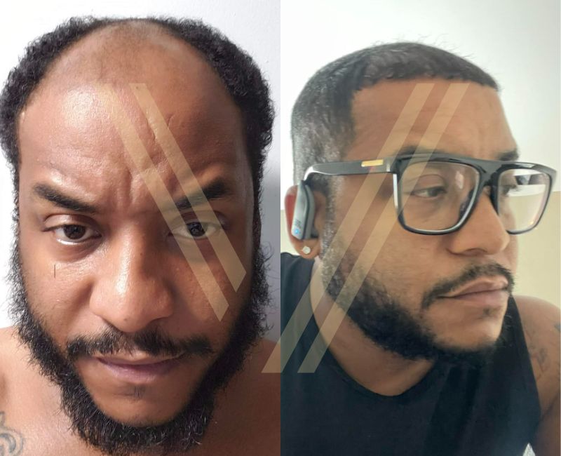 afro ethnic hair transplant before and after result
