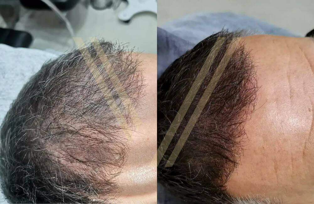 Most Natural Hair Tattoo in Texas  Houston  Austins 1 Hair loss Clinic