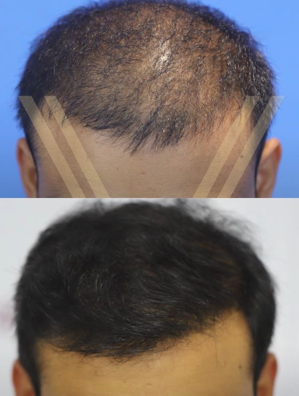hair transplant 2000 grafts result before and after