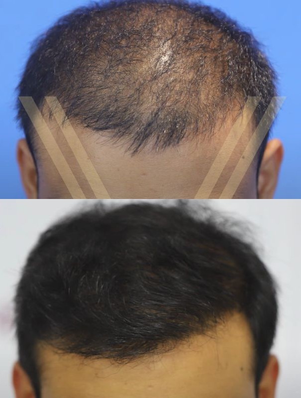 3000 Grafts Hair Transplant  Operation  Cost in 2023  Heva Clinic