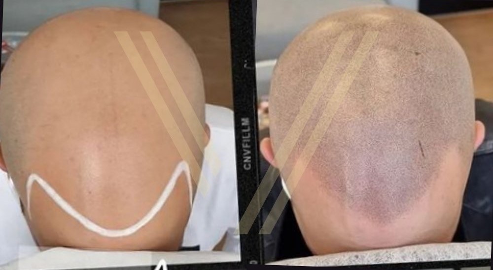 scalp micropigmentation (smp) turkey