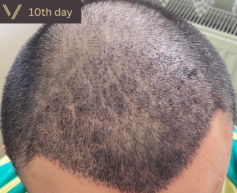 10 days after hair transplant