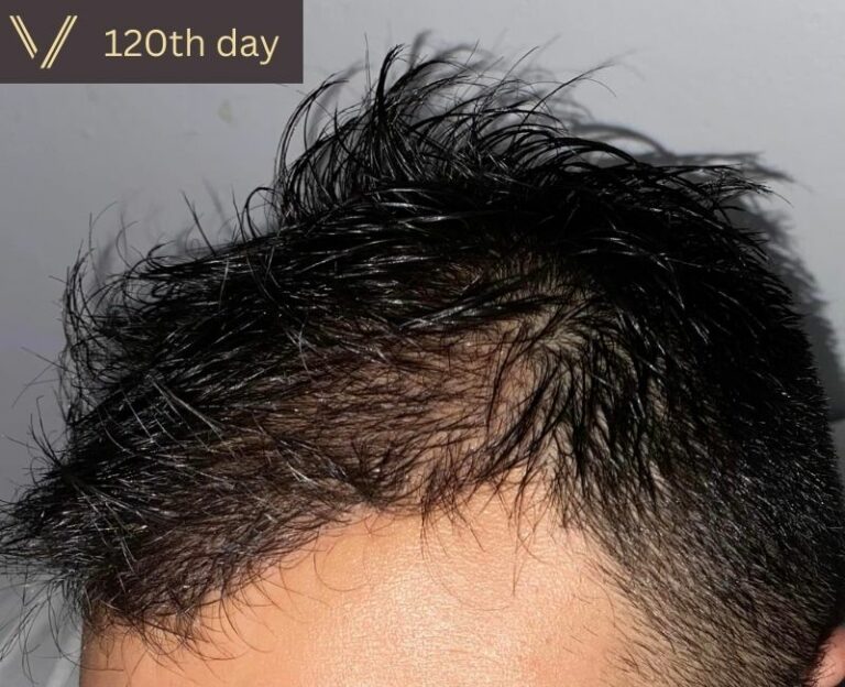 Hair Transplant Growth Timeline | Day By Day - Month By Month