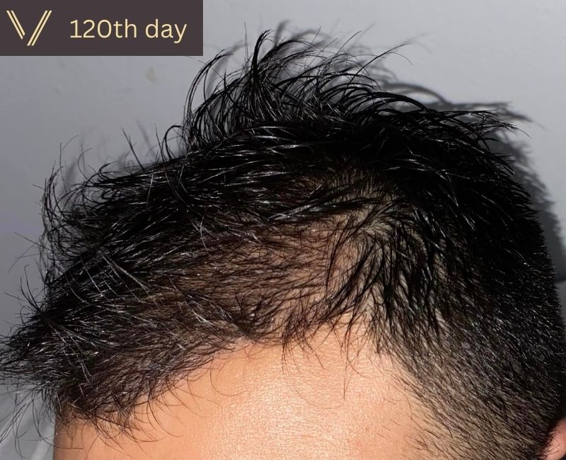 120 days after hair transplant recovery photo