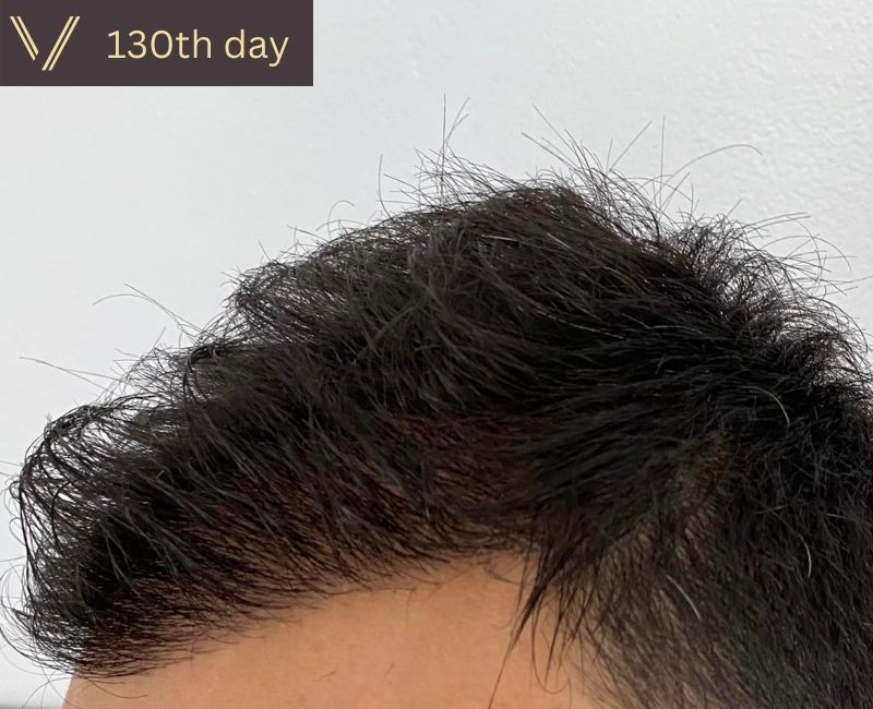 4 Months of Hair Transplant What To Expect  Pristyn Care