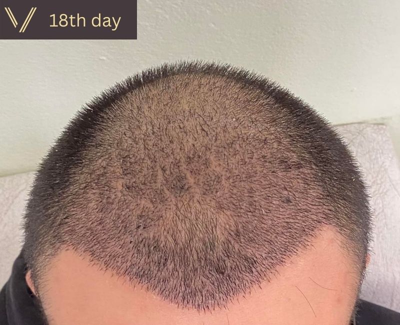 More than 2 weeks, 18 days after hair transplant recovery photo