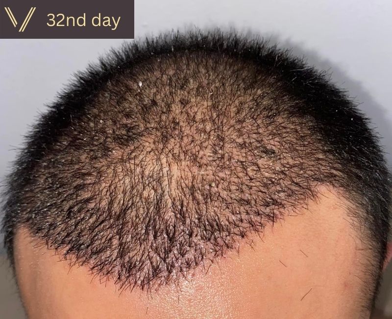 32 days after hair transplant recovery photo