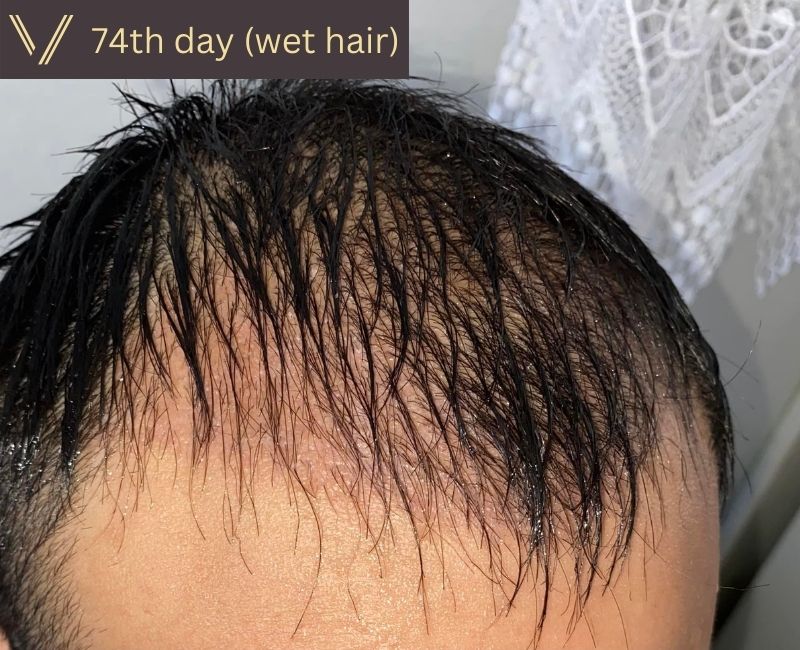 74 days after hair transplant recovery photo