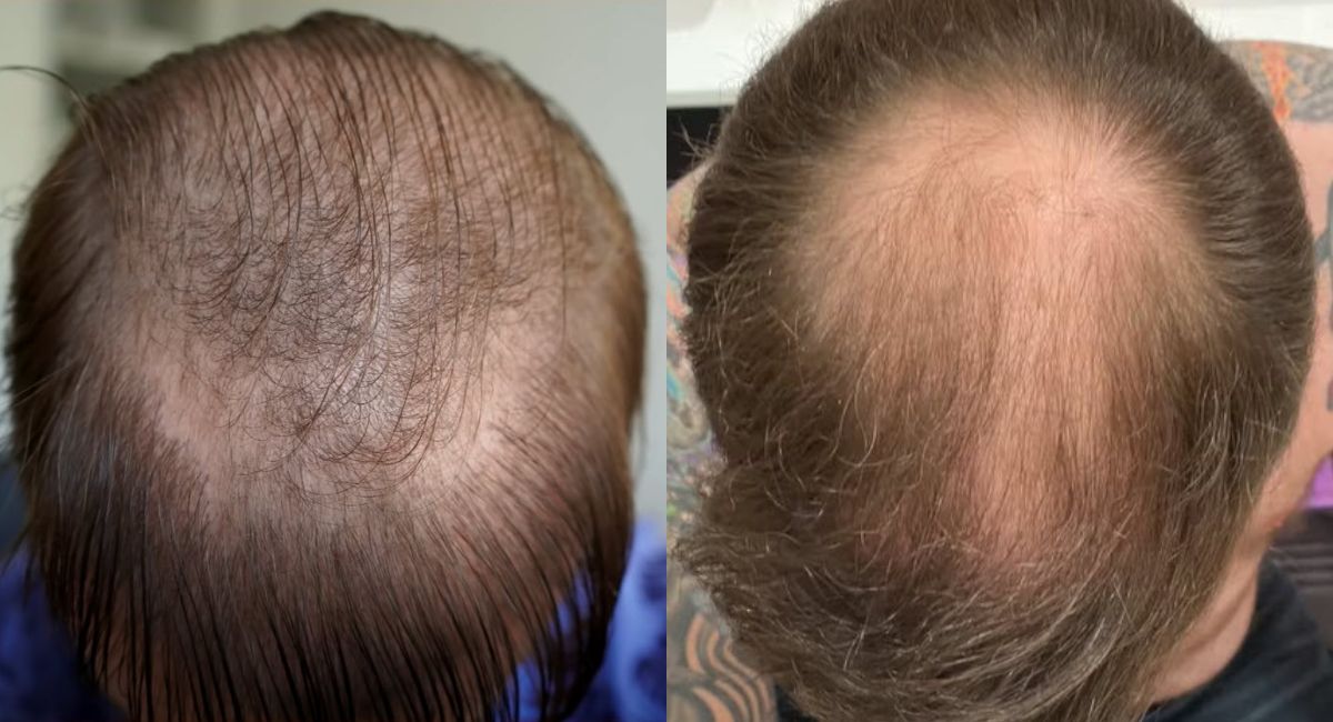 hair loss hair transplant second operation candidate