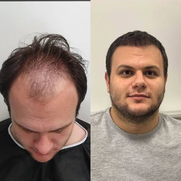 ice fue hair transplant in istanbul 5000 grafts results