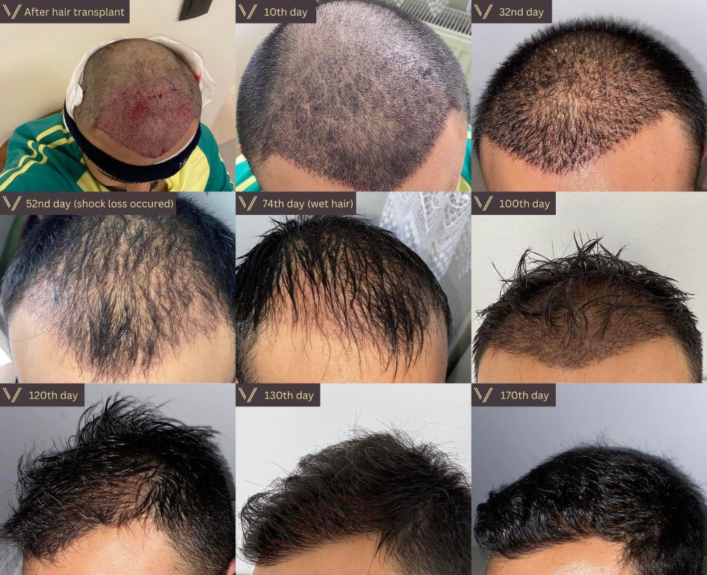 hair transplant growth recovery process collage photos
