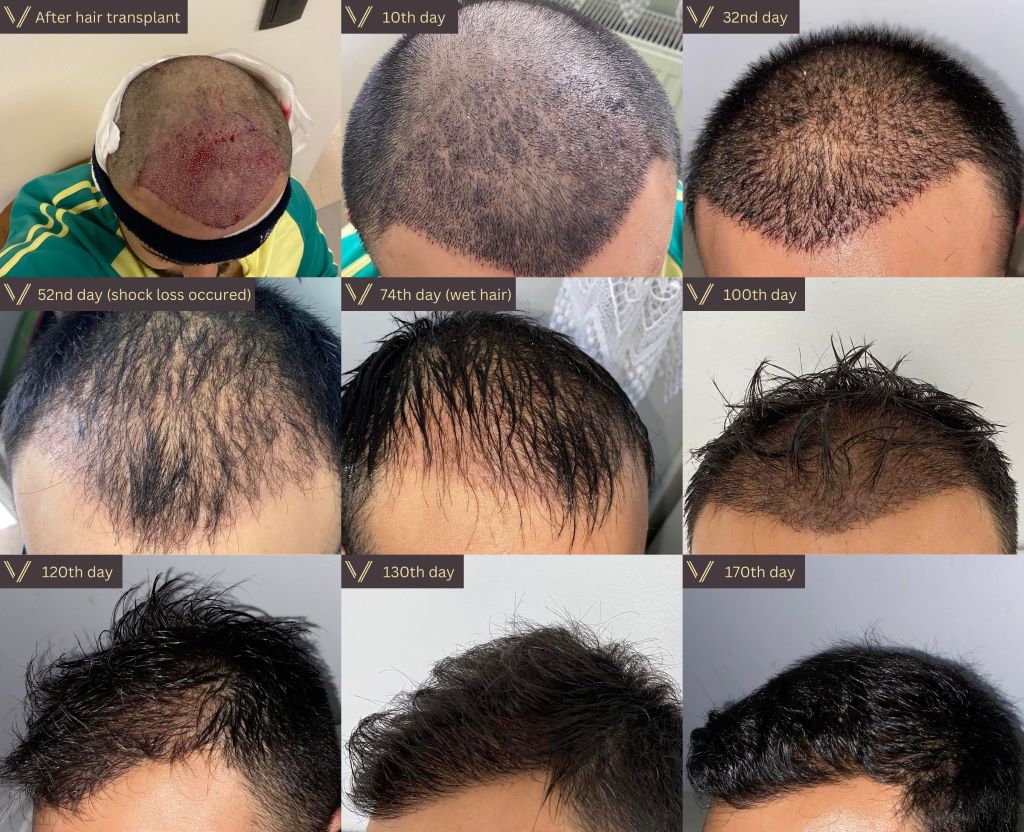 Hair Transplant Growth Timeline  Day By Day Recovery Photos