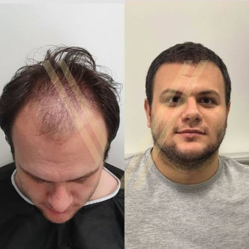 ice fue hair transplant patient in istanbul