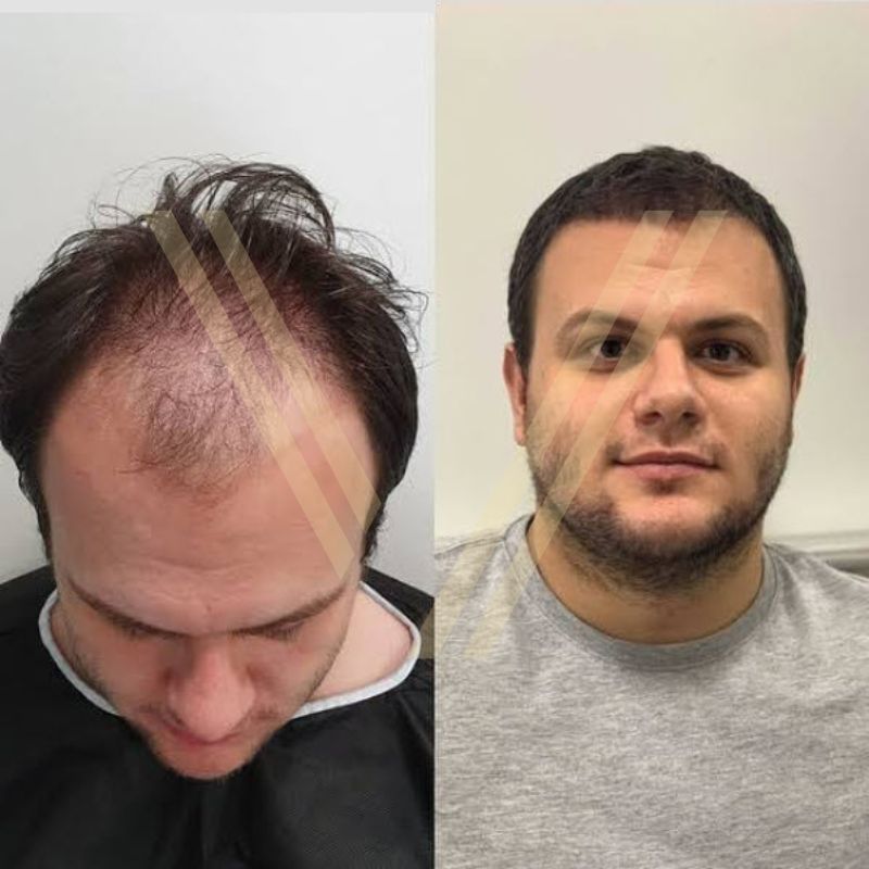 Hair of istanbul on Twitter Hair Transplantation Hair of istanbul   Whatsapp 905306884247 905343522121  905306622110 905304524414  905304085200   905306782421  httpstco7GPMdxkwnE  Twitter