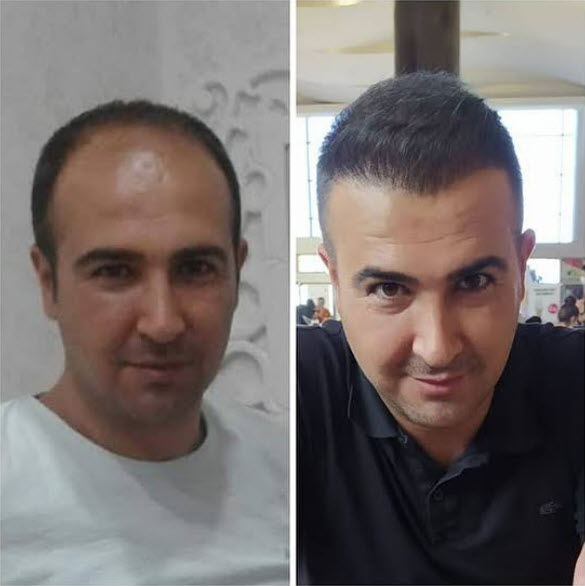 istanbul hair transplant 7 months result