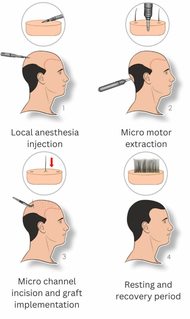 micro fue hair transplant procedure steps