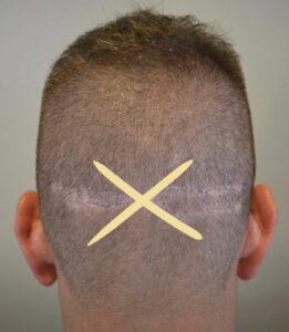 no scarring micro motor fue