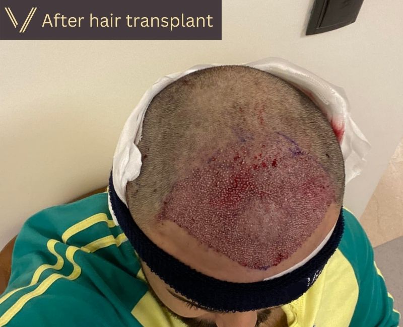 right after hair transplant