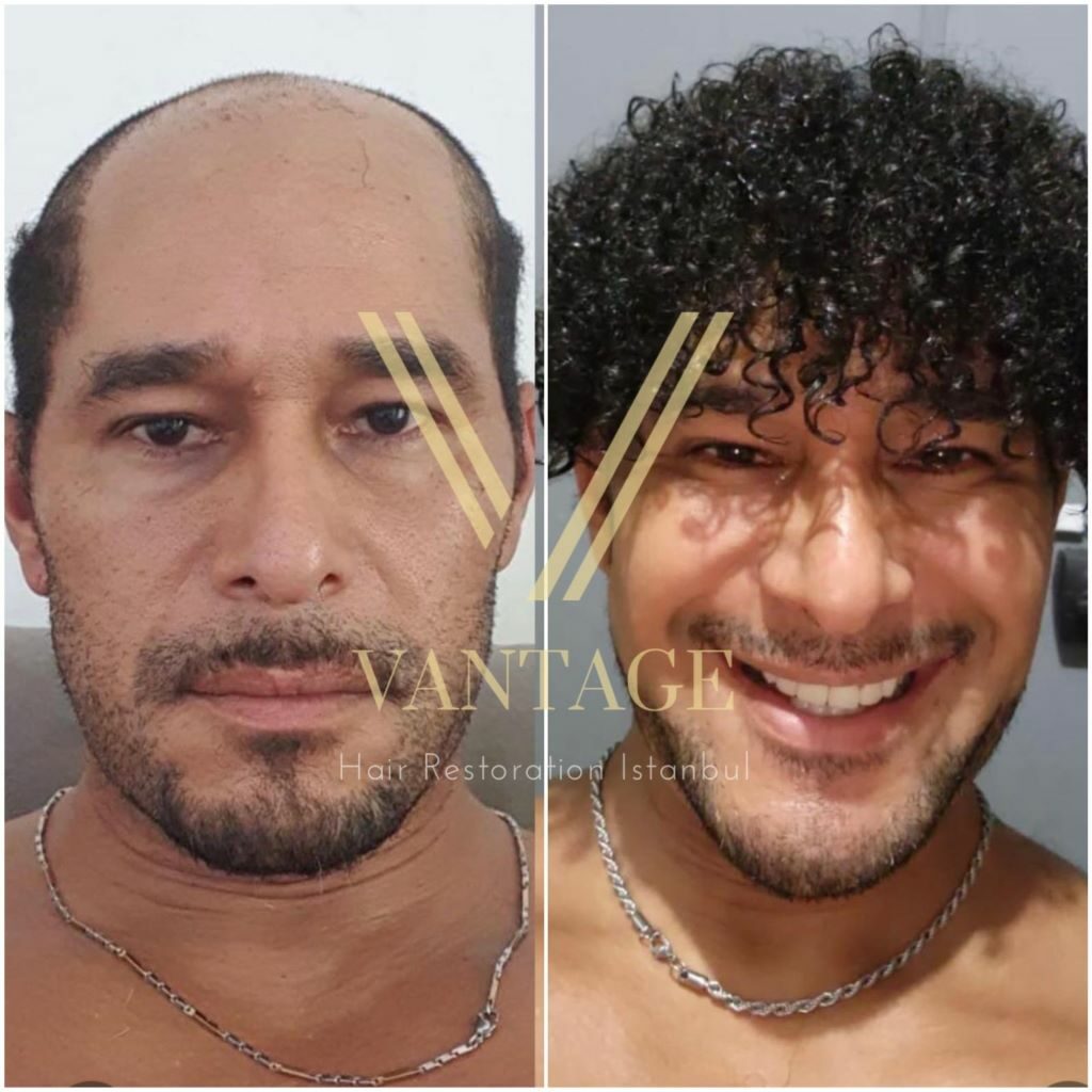 6000 grafts hair transplant before and after picture