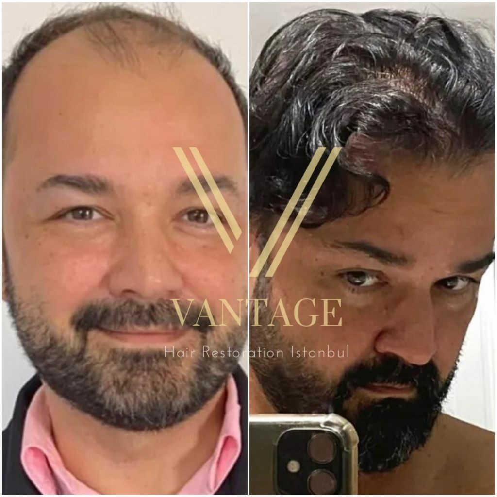 above 5000 grafts hair transplant before and after