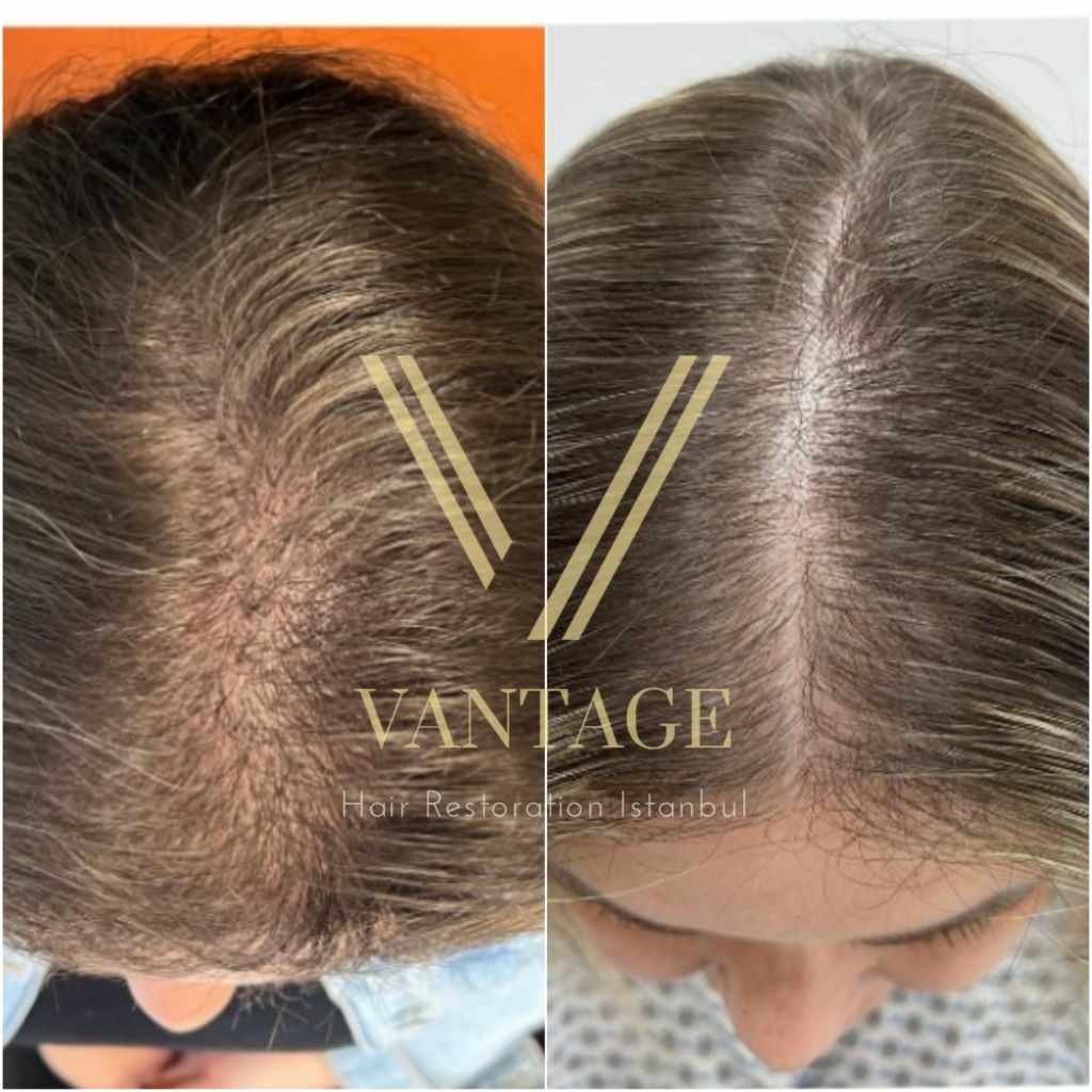female pattern hair loss transplant before and after