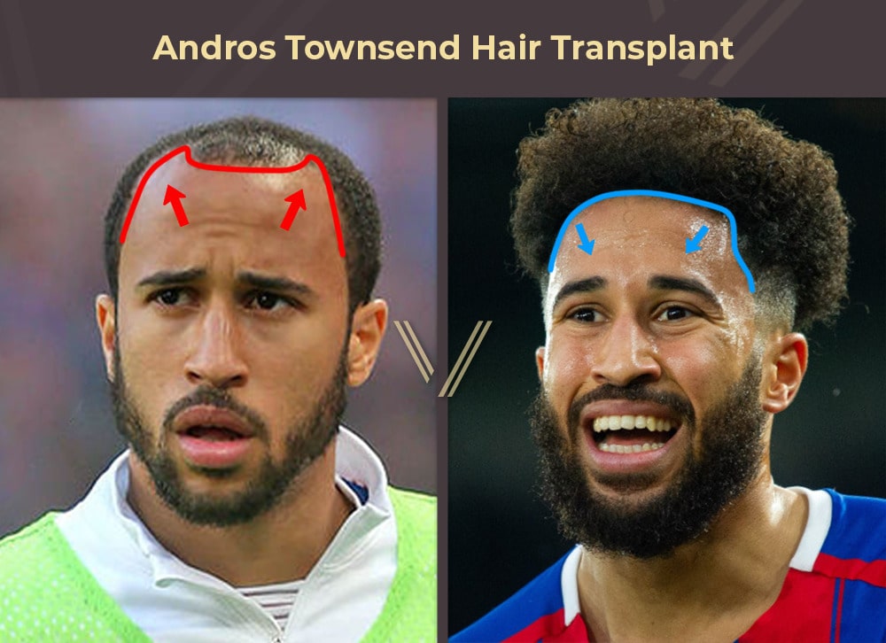 Andros Townsend Hair Transplant Before and After