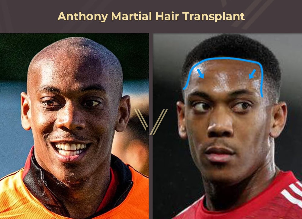 Anthony Martial Hair Transplant Before and After