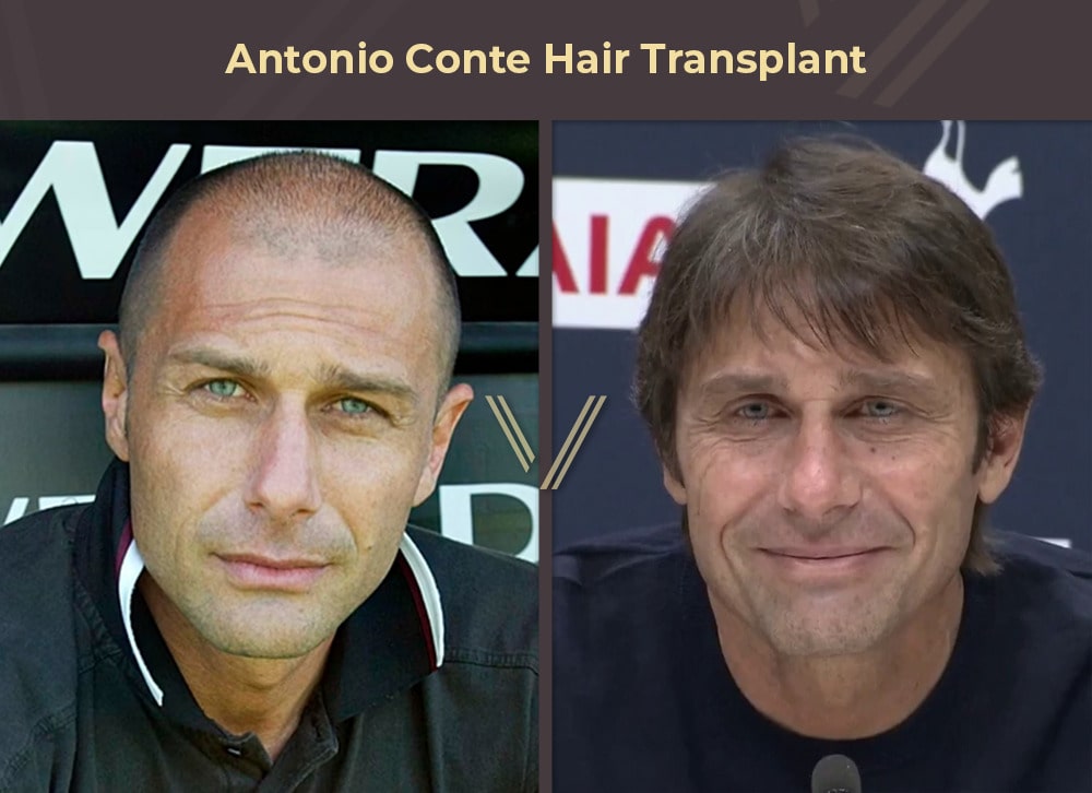 Antonio Conte Hair Transplant Before and After