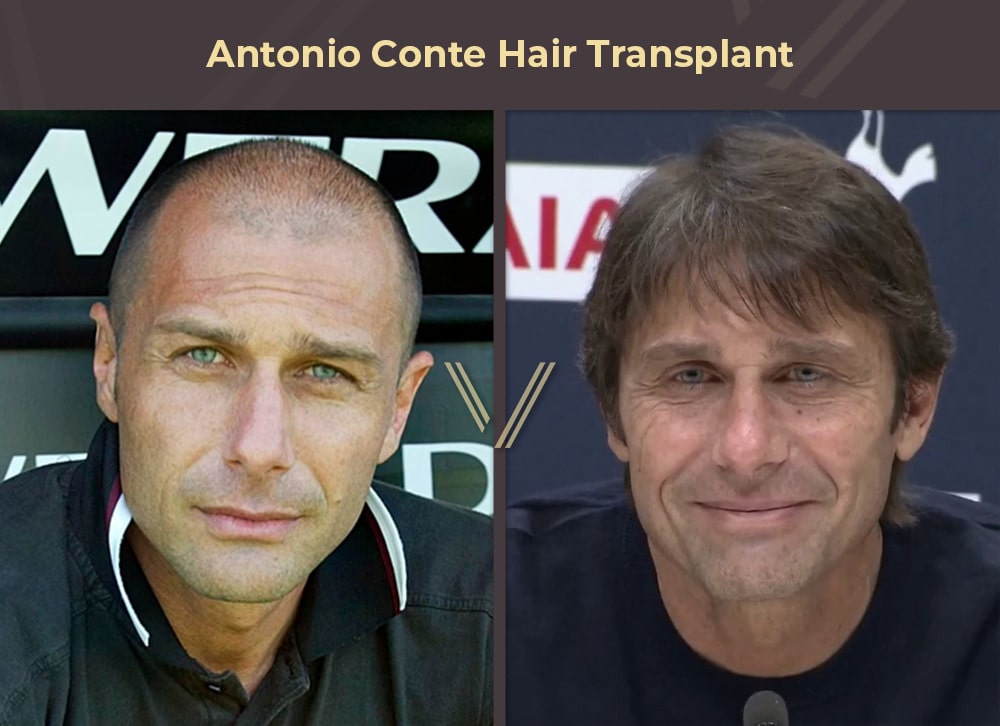 Celebrities With Hair Transplants 94 Before After Photos