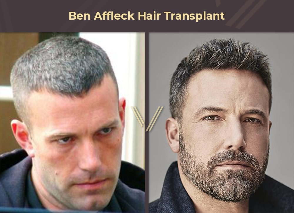 Ben Affleck Hair Transplant Before and After