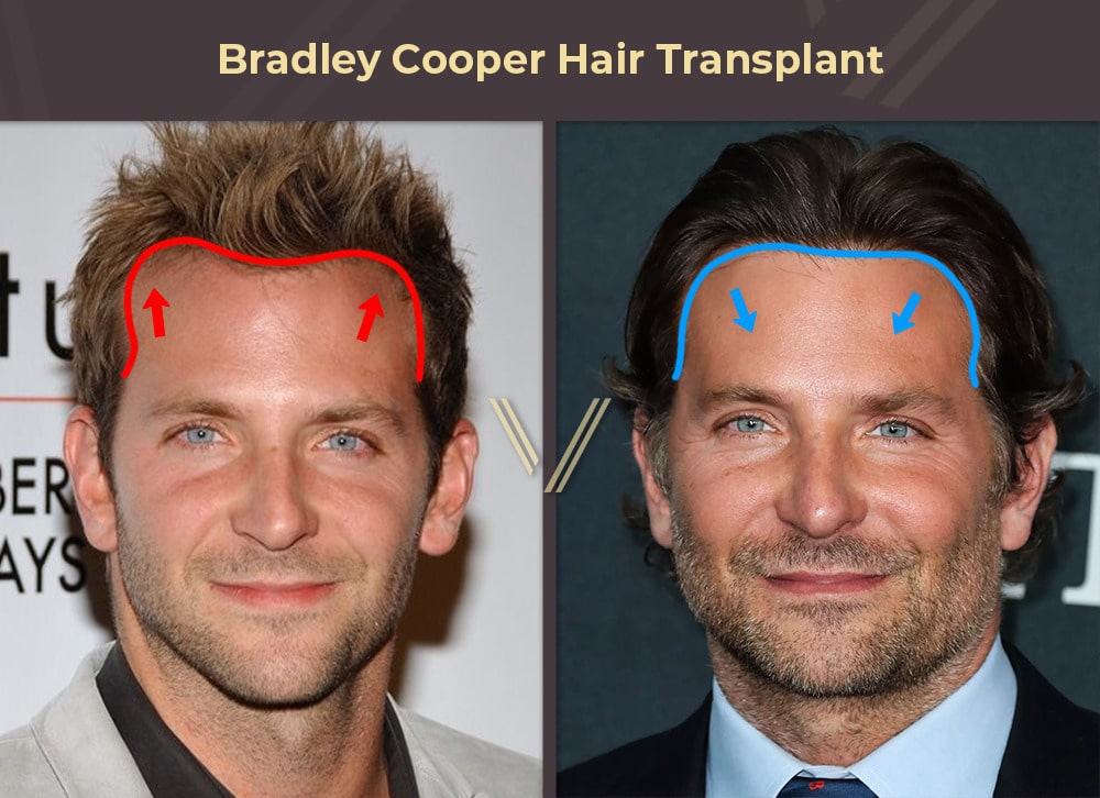 Bradley Cooper Hair Transplant Before and After