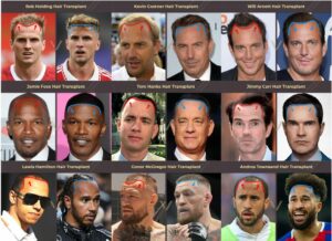Celebrities With Hair Transplants | 104 Before & After Photos