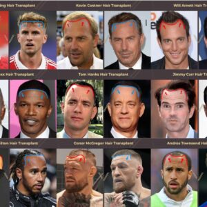 Celebrity hair transplant before and after gallery banner