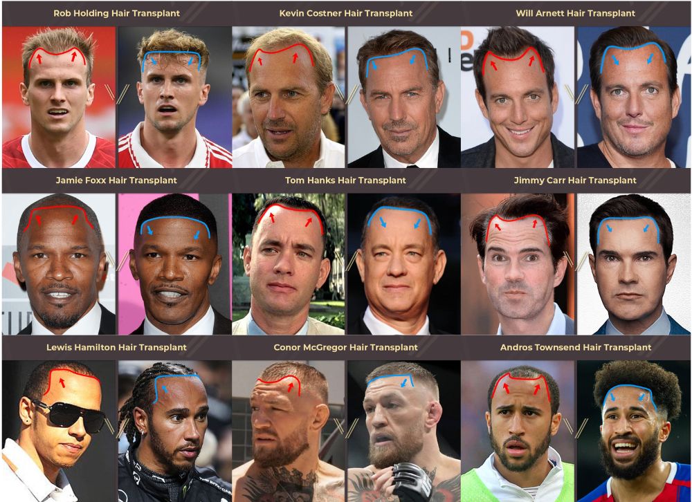 Celebrity hair transplant before and after gallery banner