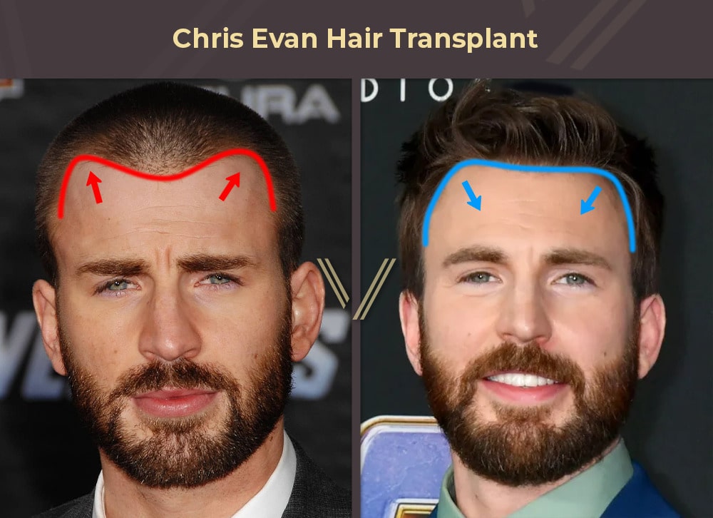 Chris Evan Hair Transplant Before and After