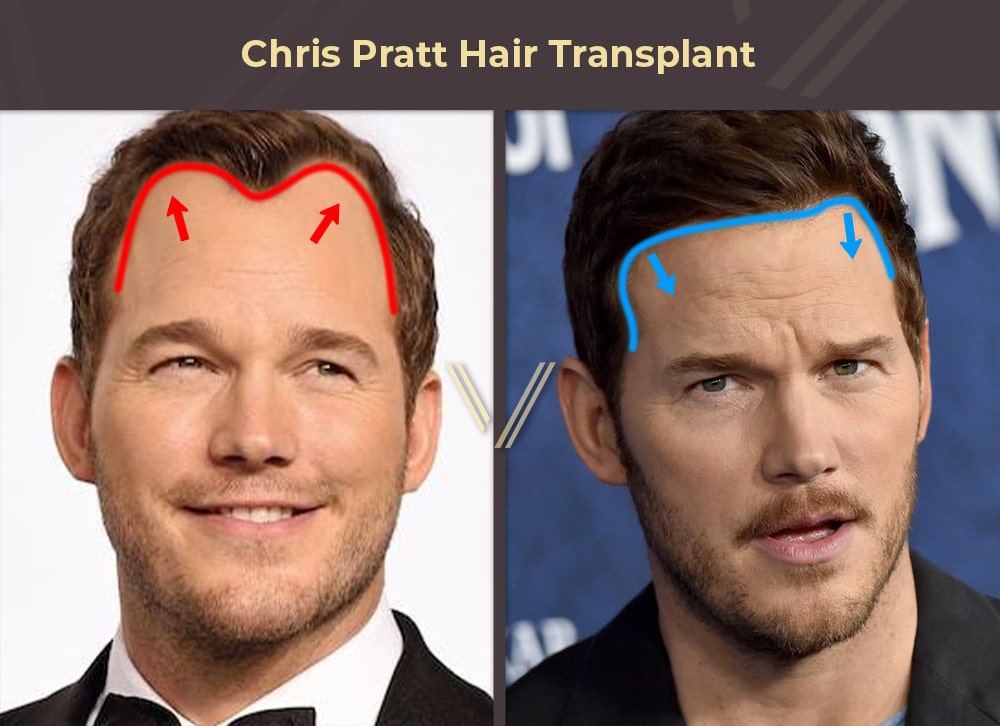 Chris Pratt Hair Transplant Before and After