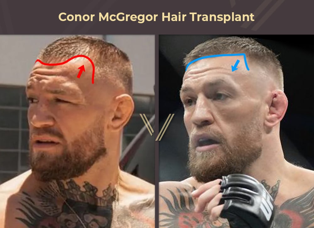 Conor McGregor Hair Transplant Before and After