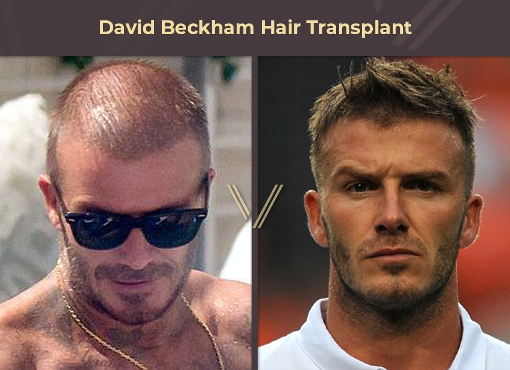 David Beckham hides his hair after 'hair transplant' rumours