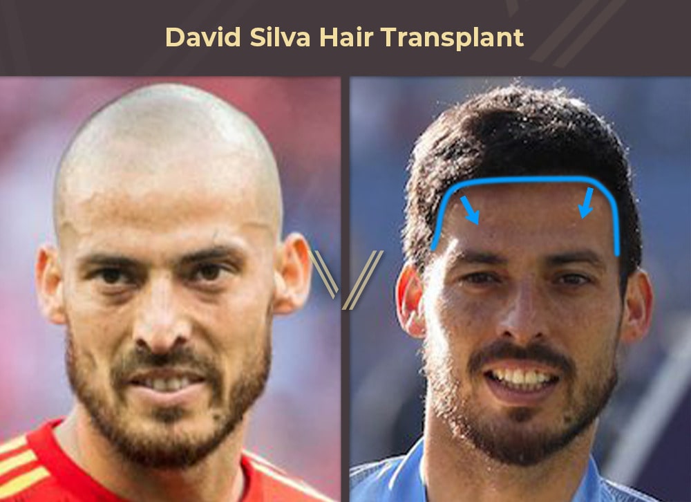 David Silva Hair Transplant Before and After