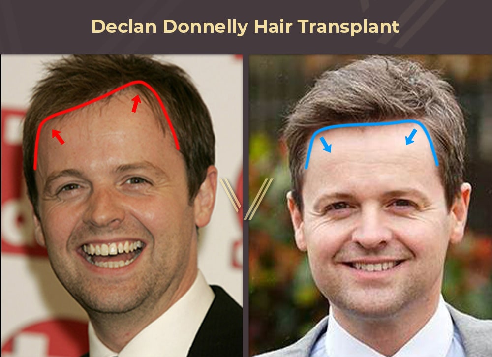 Declan Donnelly Hair Transplant Before and After