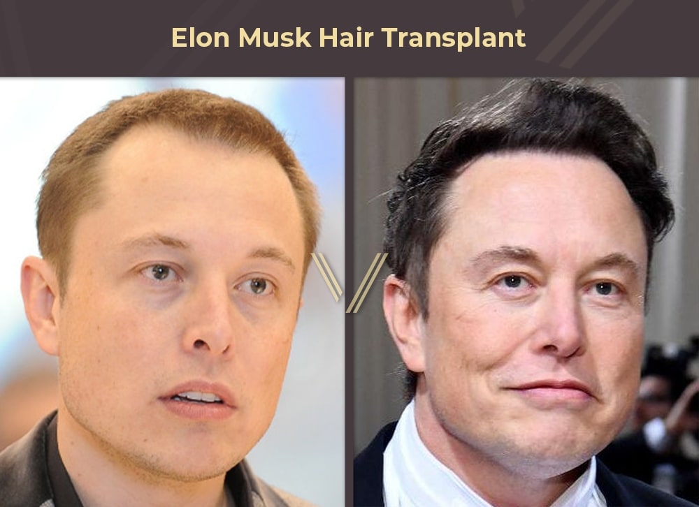 Elon Musk Hair Transplant Before and After