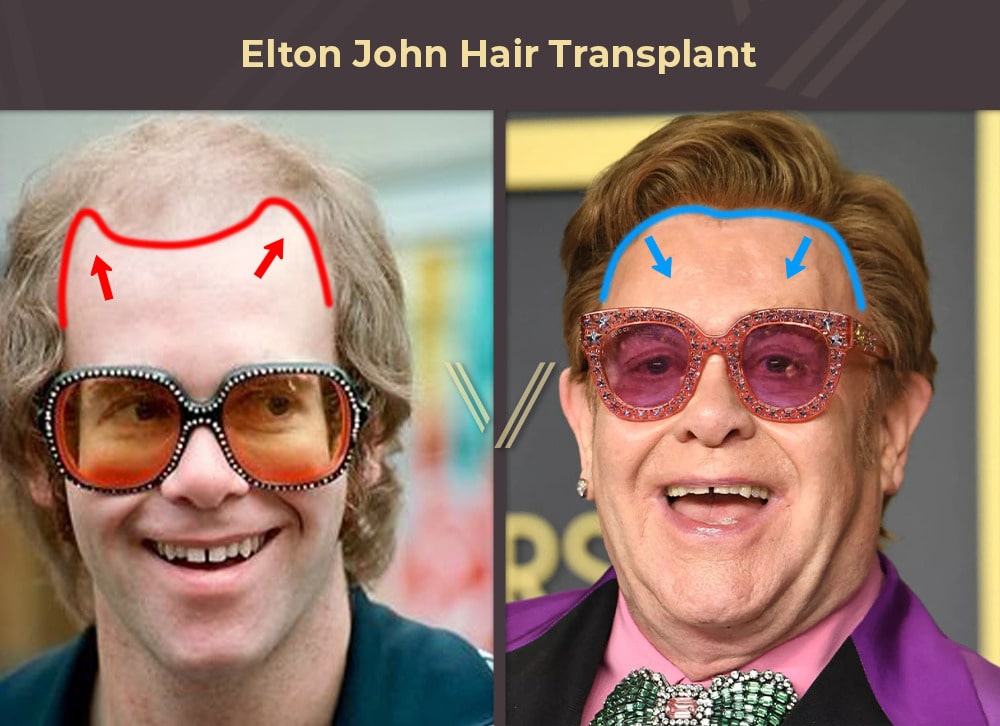 Elton John Hair Transplant Before and After
