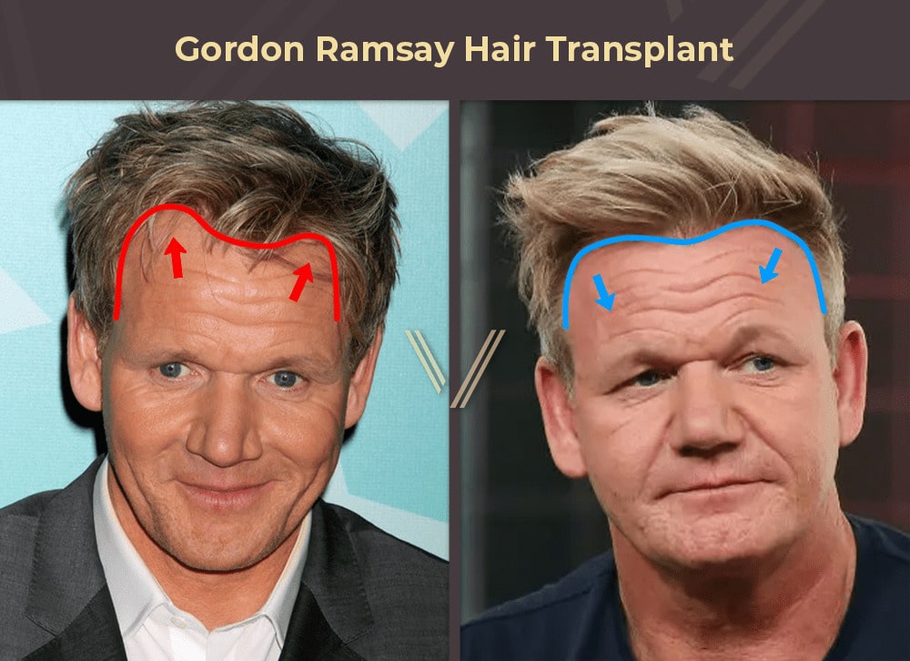 Celebrities With Hair Transplants 94 Before After Photos