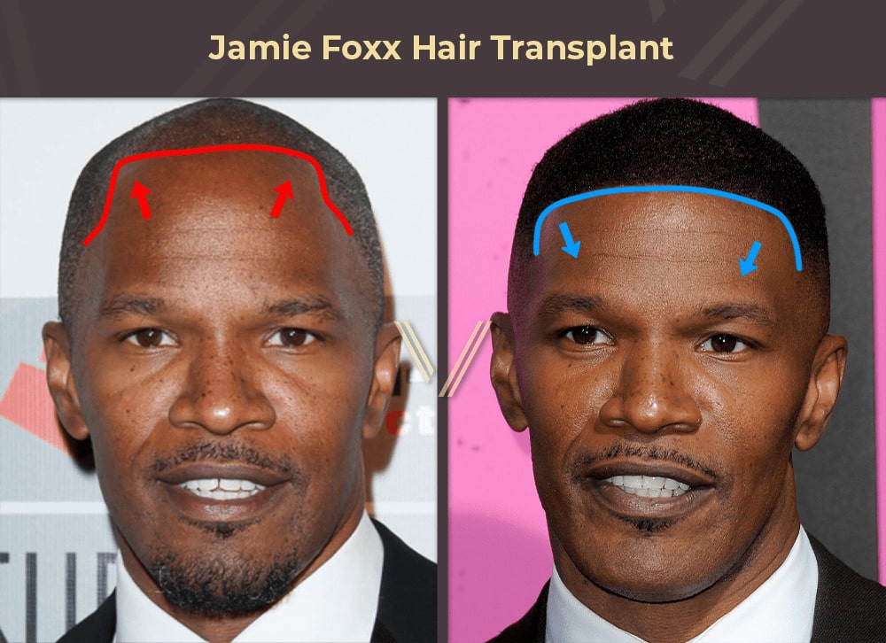 Jamie Foxx Hair Transplant Before and After