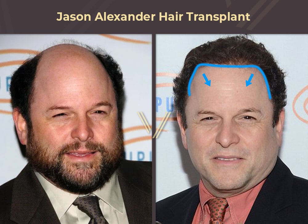 Celebrities With Hair Transplants 94 Before After Photos