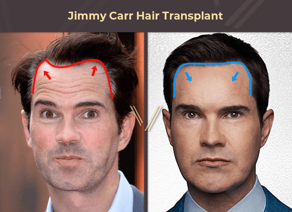 Jimmy Carr Hair Transplant Before and After