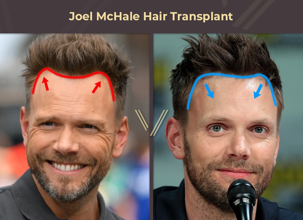 Joel McHale Hair Transplant Before and After