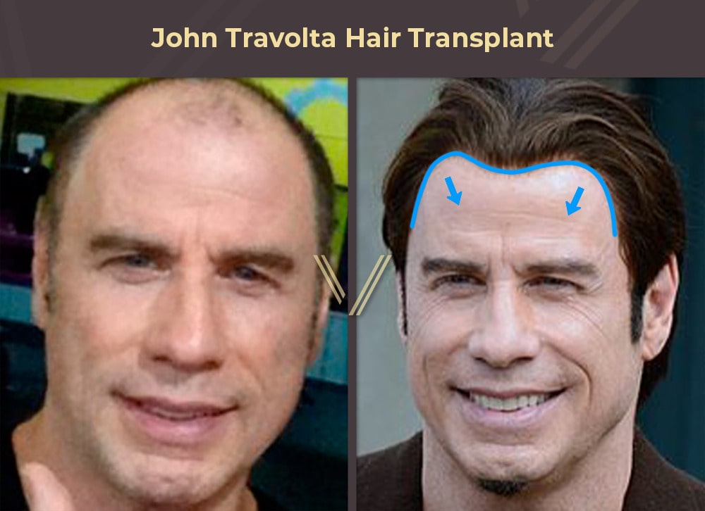 John Travolta Hair Transplant Before and After